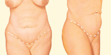 Abdominoplastia