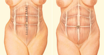 Abdominoplastia