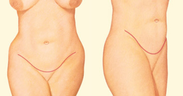 Abdominoplastia