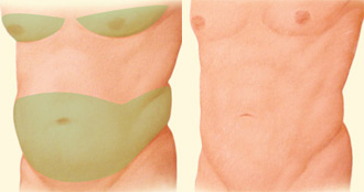 Liposucción