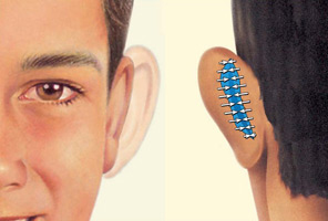 Otoplastia diagrama