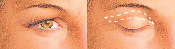 Blefaroplastia diagrama