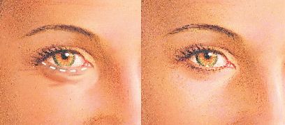 Blefaroplastia diagrama