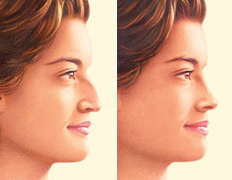 Rinoplastia