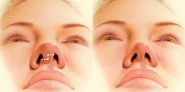 Rinoplastia